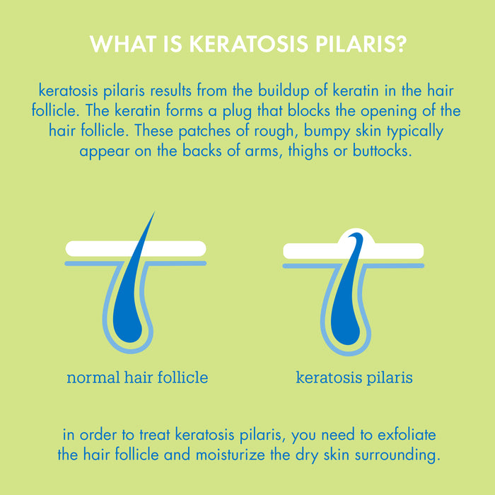 Keratosis Pilaris Infographic 