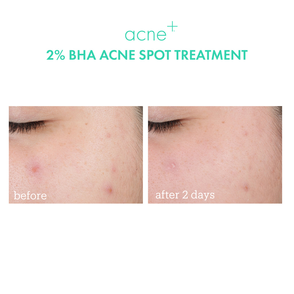 acne+ spot treatment before + after 2 days 
