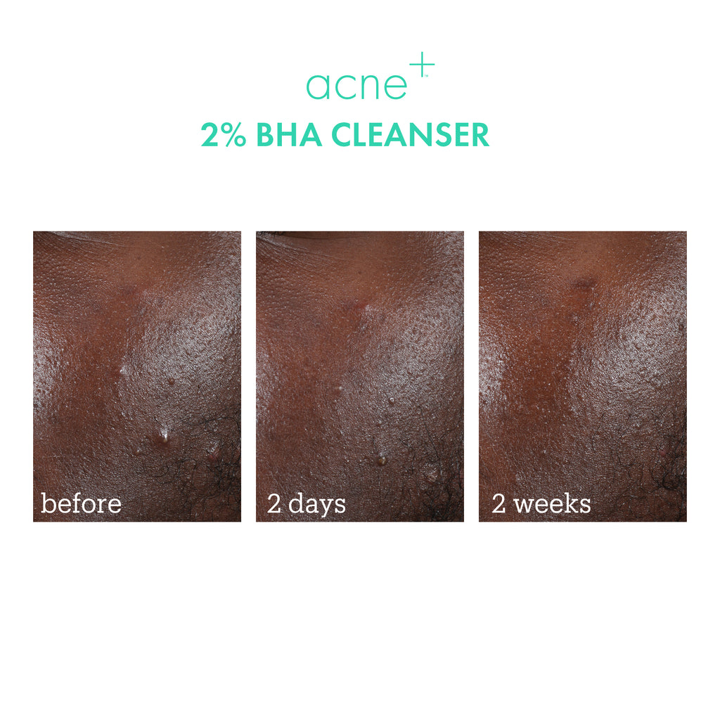Acne+ 2% BHA Cleanser before & after